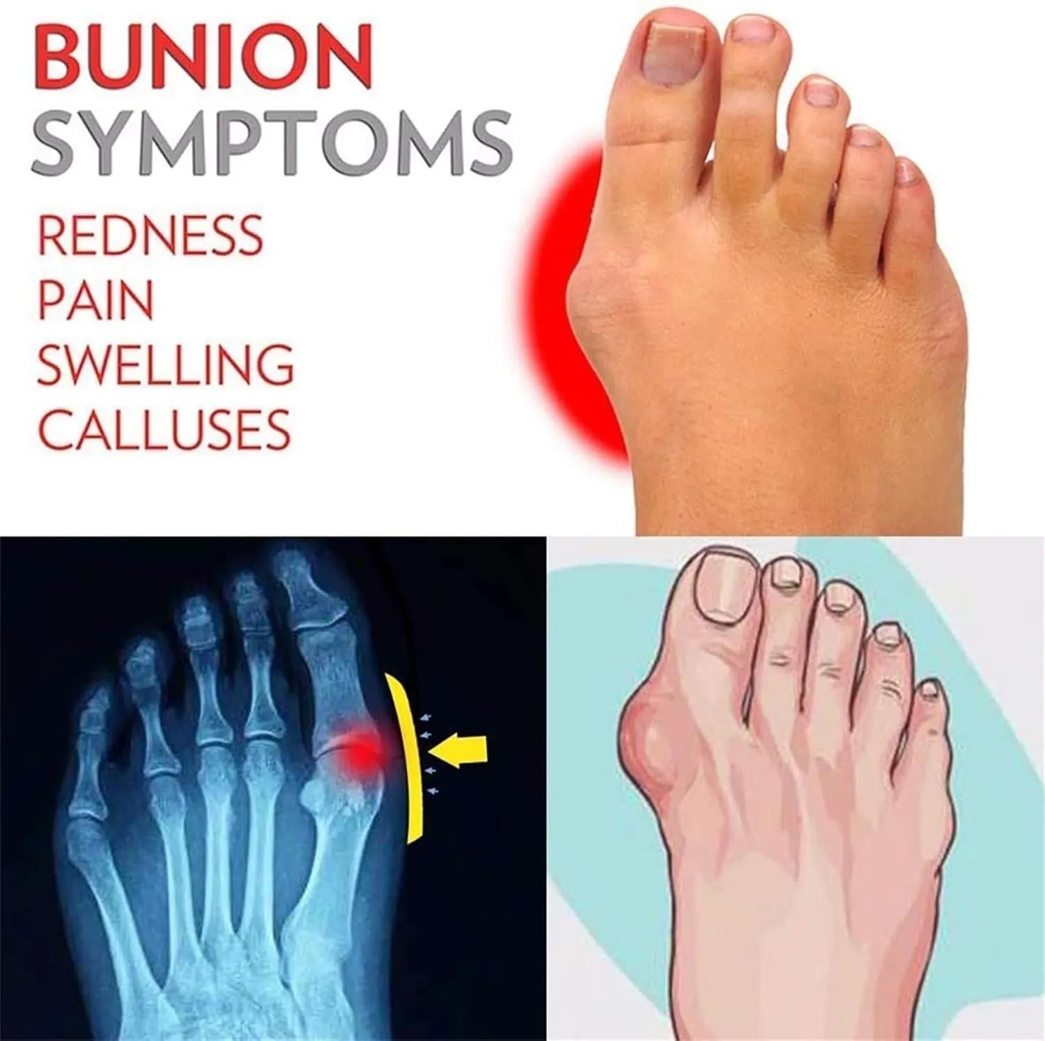 Women Flat Thong Sandals, Women's Summer Slip-On Comfort Bunion Corrector Flat Shoes, Casual Fashion Slides and Split Toes, for Orthopedic Big Toe Bone Correction, Beach Travel